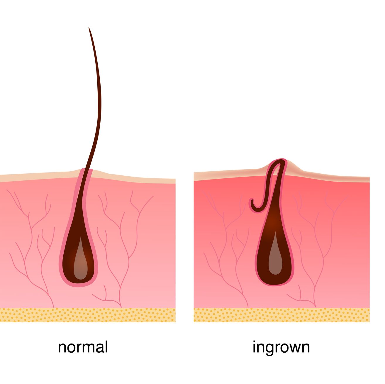 ingrown hair scrotum treatment