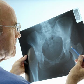 an experienced caucasian orthopaedic surgeon doctor examining a pelvic x ray displaying signs of osteoporosis hip degeneration actual x ray of a 42 year old woman with a degenerative hip the orthopaedic surgeon is using a pencil to point at the hip where the problem is this patient is a candidate real for hip replacement the dominant colour is blue
