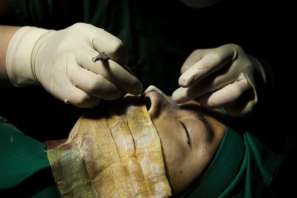beijing   may 12   a chinese man undergoes a rhinoplasty procedure at the shisanba cosmetic surgery hospital may 12, 2011 in beijing, china  the man, who owns a small it firm and would only give his surname chen, spent approximately $1100 usd on the procedure  cosmetic surgery is on the rise in china as more middle class chinese are able to afford the expensive procedures  jonathan sarukgetty images