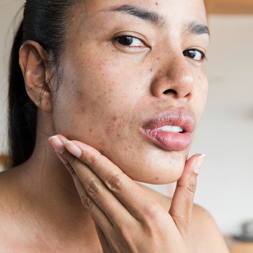 woman with acne looking at her skin