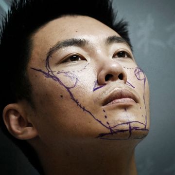 topshot   this picture taken on july 15, 2021 shows scientific researcher xia shurong with markings on his face before having plastic surgery at a clinic in beijing   worried his appearance would detract from opportunities in china's competitive society, xia shurong decided to go under the surgeon's knife to reshape his nose    joining millions of young chinese men turning to cosmetic surgery   to go with china social surgery gender,feature by leo ramirez and qian ye photo by wang zhao  afp  to go with china social surgery gender,feature by leo ramirez and qian ye photo by wang zhaoafp via getty images