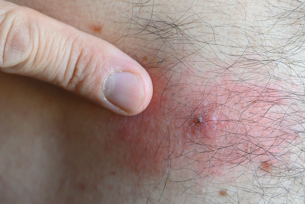 close up of infected tick bite