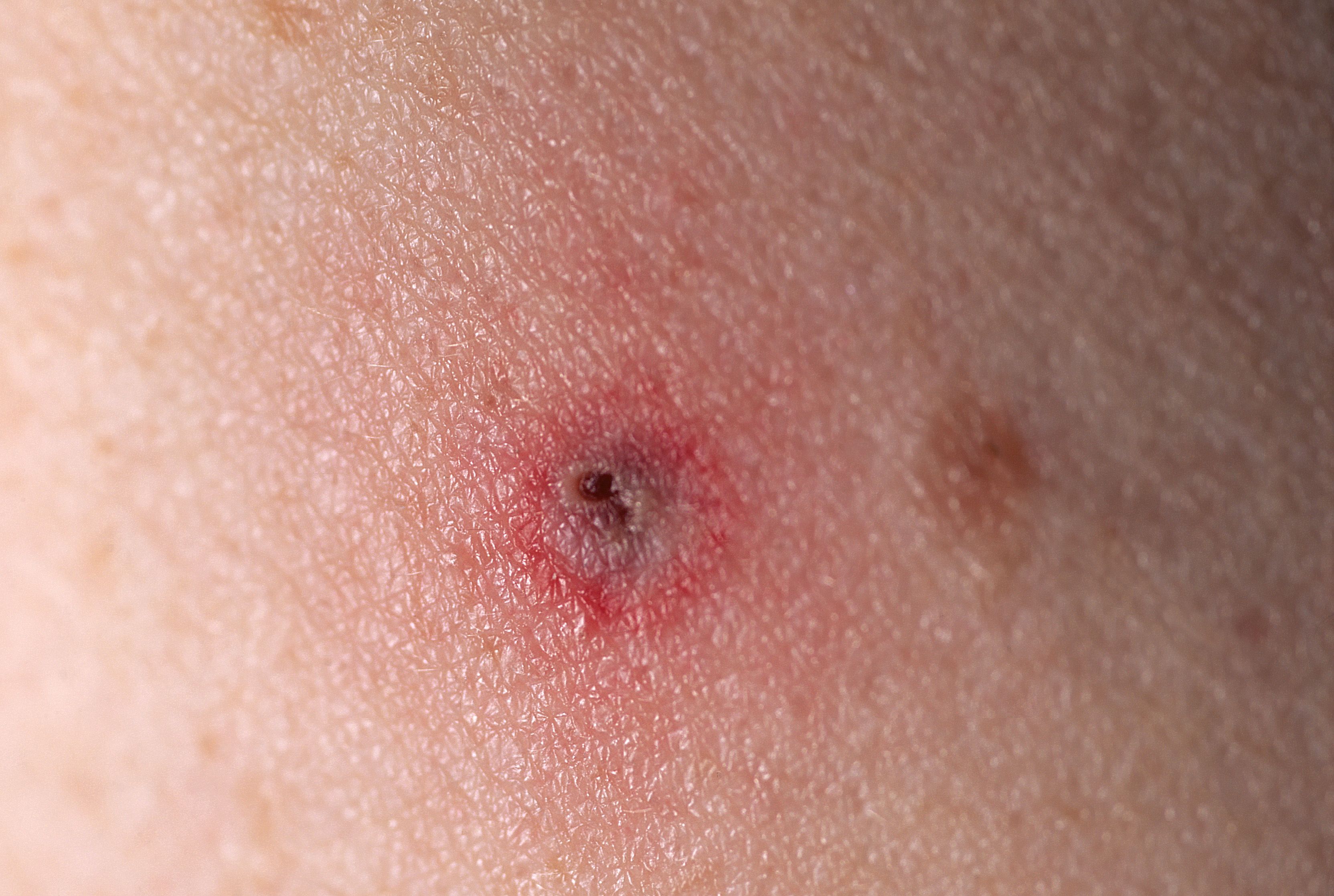 tick infestation human skin