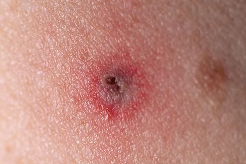 tick bite rash
