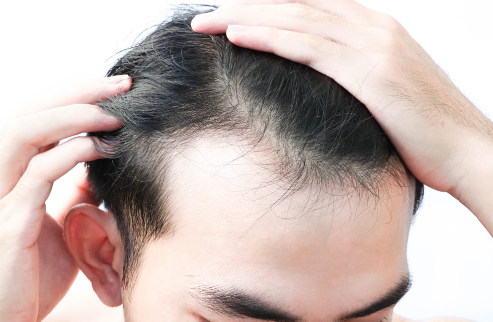 young man serious hair loss problem for health care shampoo and beauty product concept