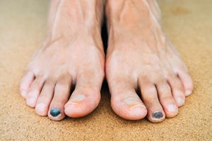 small, painless, black and blue discoloration beneath the nailhow to stop a black toenail from ruining your runs