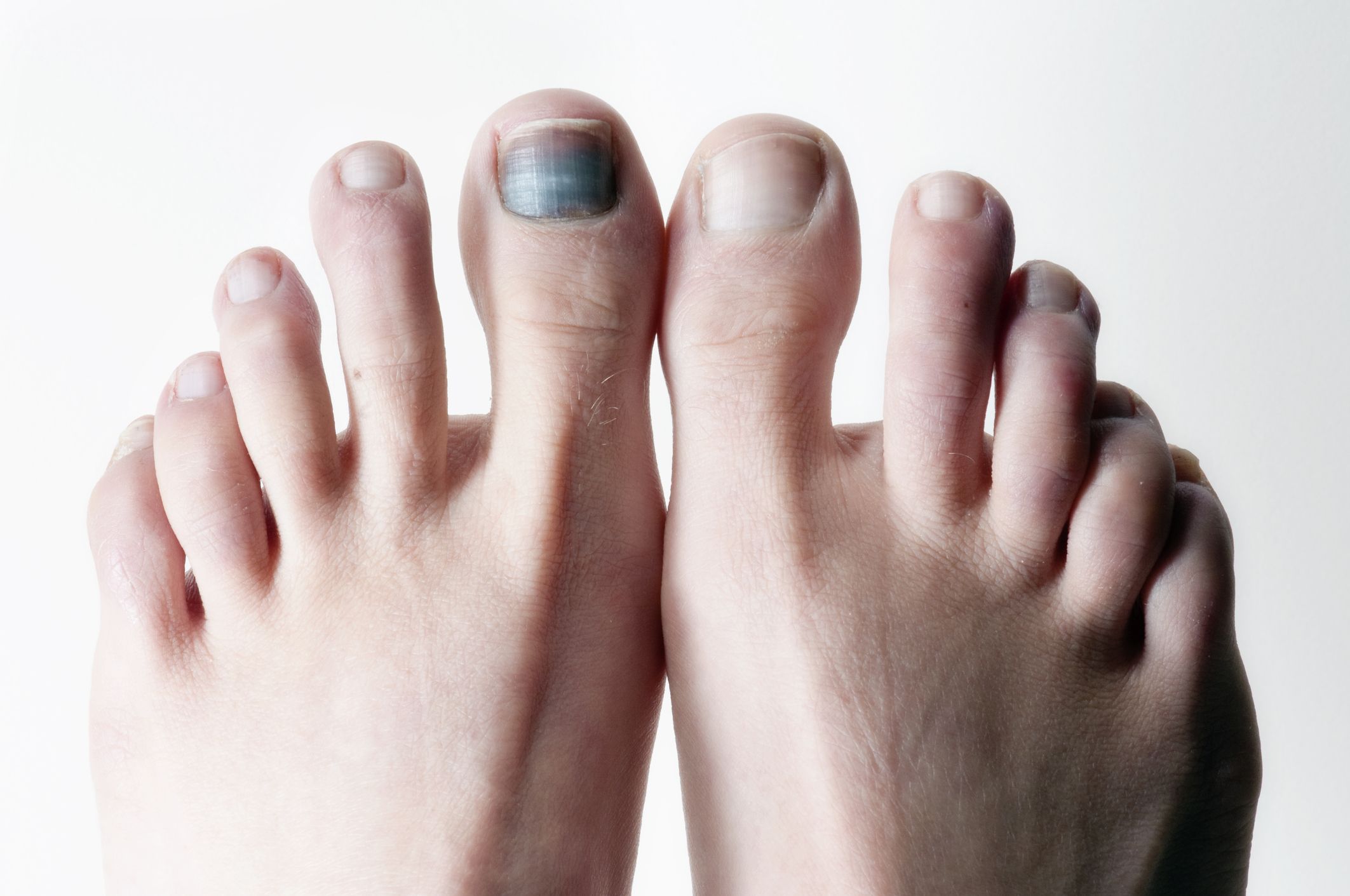Nail Injury Treatment of Bruises and Fractures. Damage To the Nail Phalanx.  the Effect of Wearing Uncomfortable Shoes Stock Image - Image of infection,  bruises: 176681169