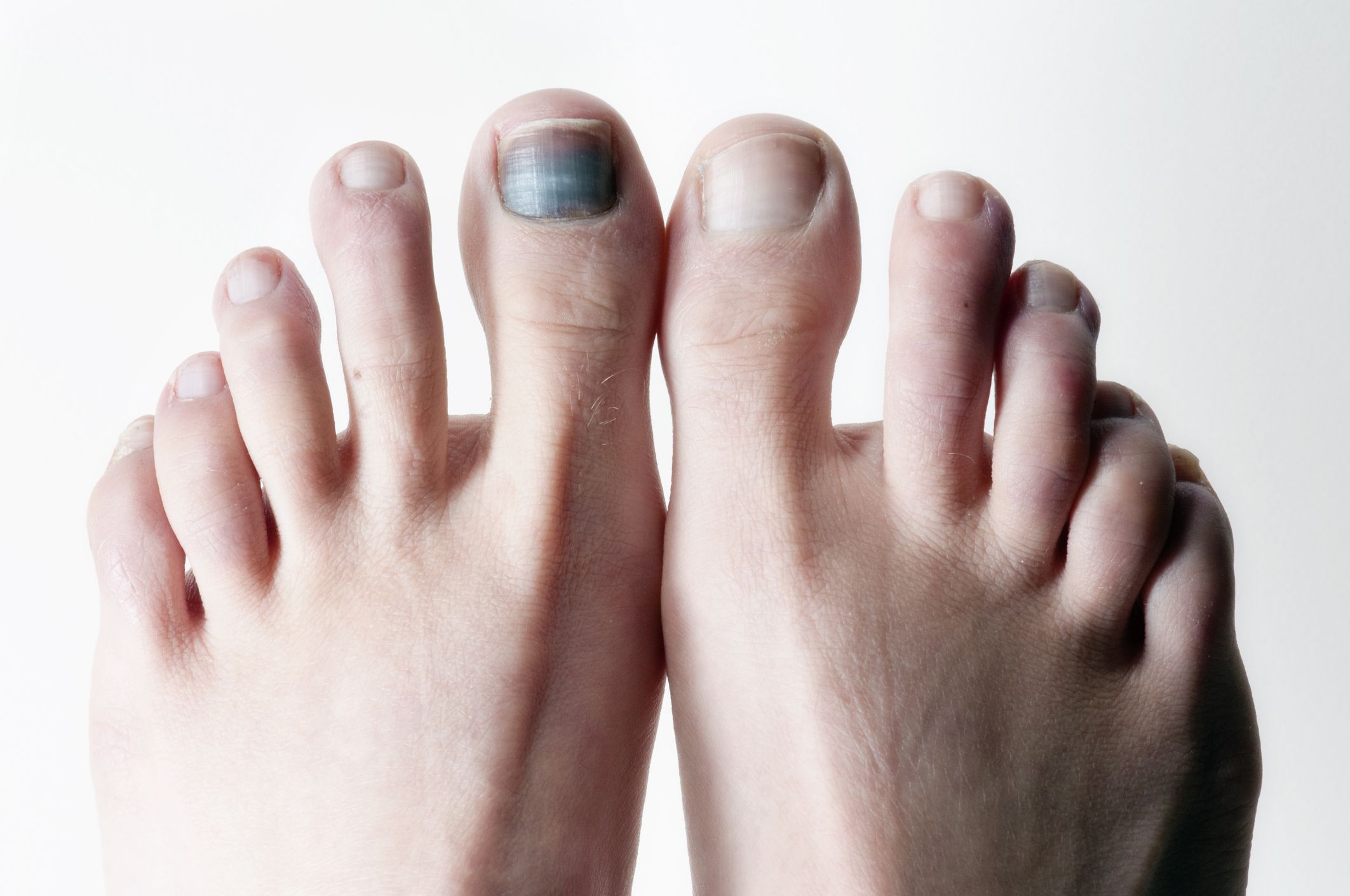 How to Fix BIG TOE Pain for Good - YouTube