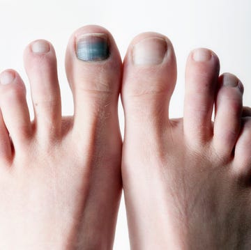 black toenail