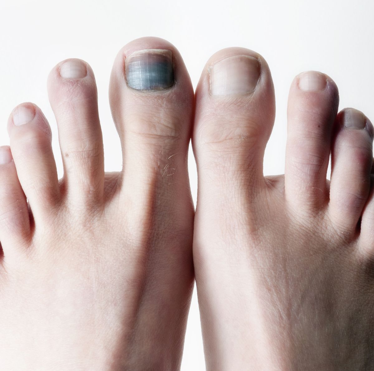 Black Toenails: Causes, Prevention Tips, and How to Treat