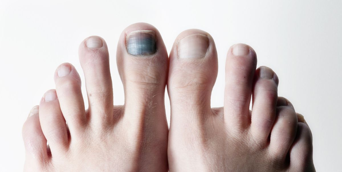 Почему ногти синеют причина. Гематома подногтевая гематома. Почернение пальца на ноге.