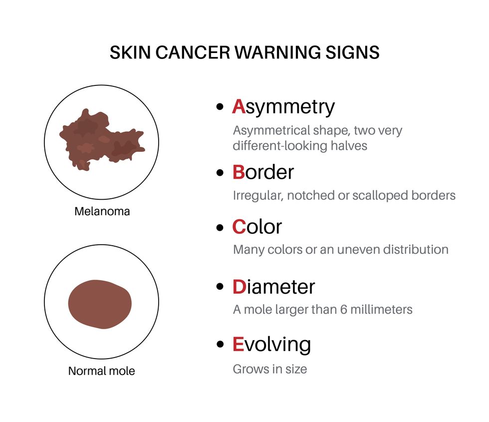 melanoma and normal mole comparison, skin cancer warning signs, abcde rules poster malignant tumor melanocyte cells growing into skin layers oncology prevention medical flat vector illustration
