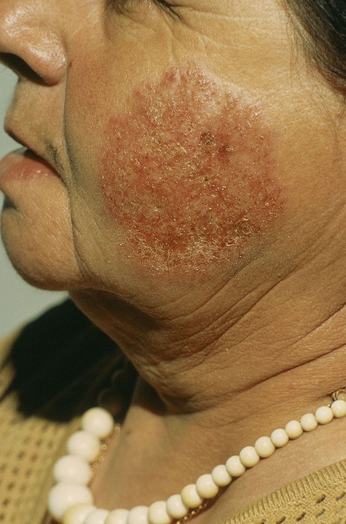 Eczema On The Face: Symptoms, Causes, Treatment And Prevention