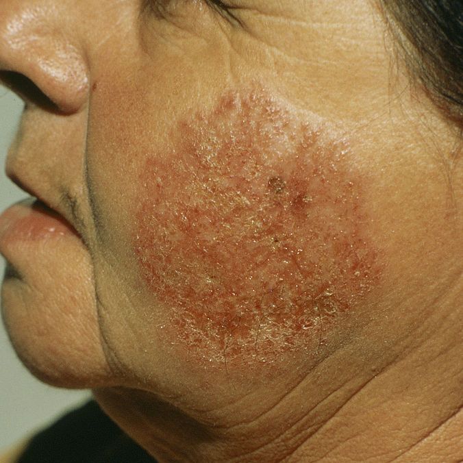 eczema face