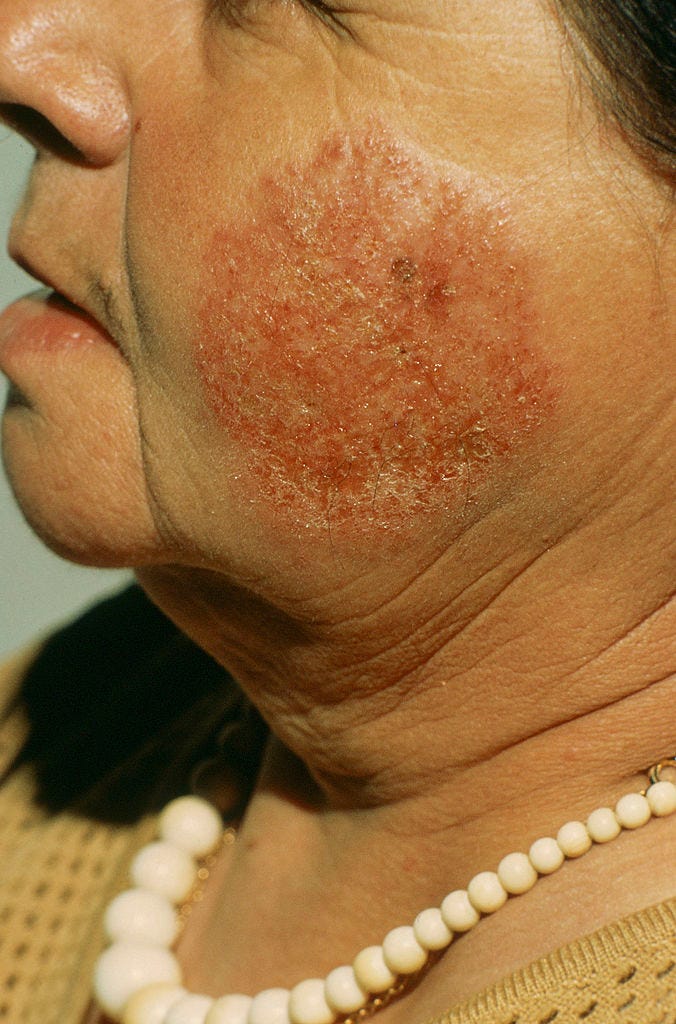 Eczema On The Face Symptoms Causes Treatment And Prevention