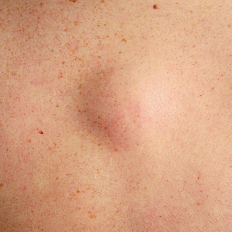 red bumps on skin not itchy