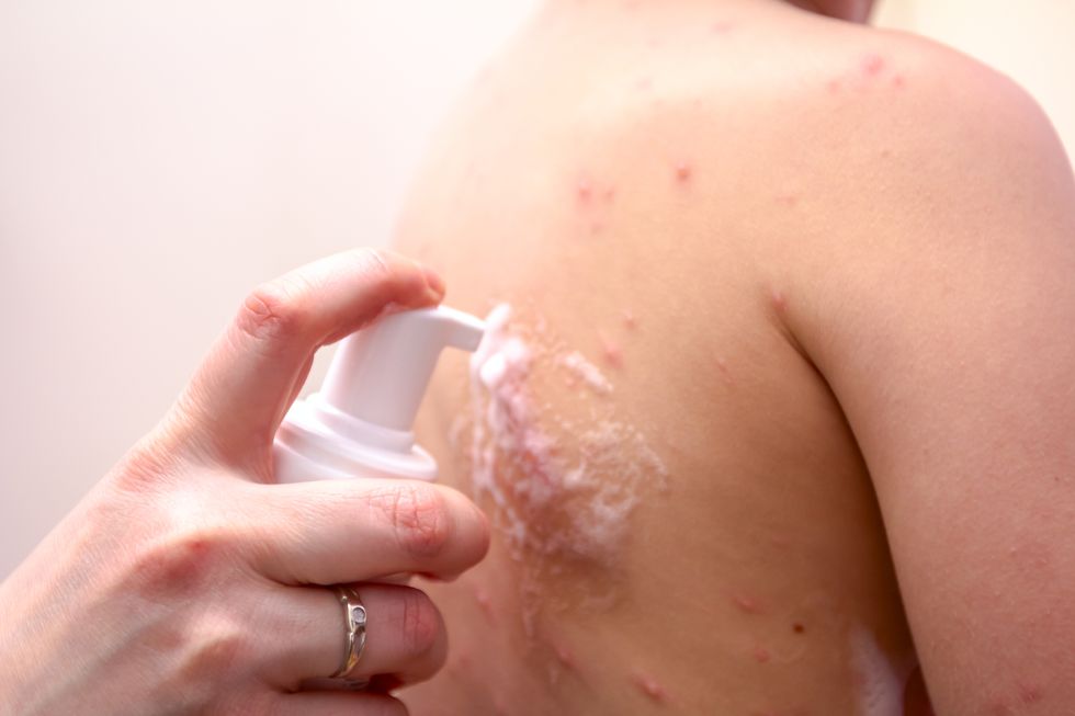 child skin infected with chickenpox is having treatment using antiseptic foam