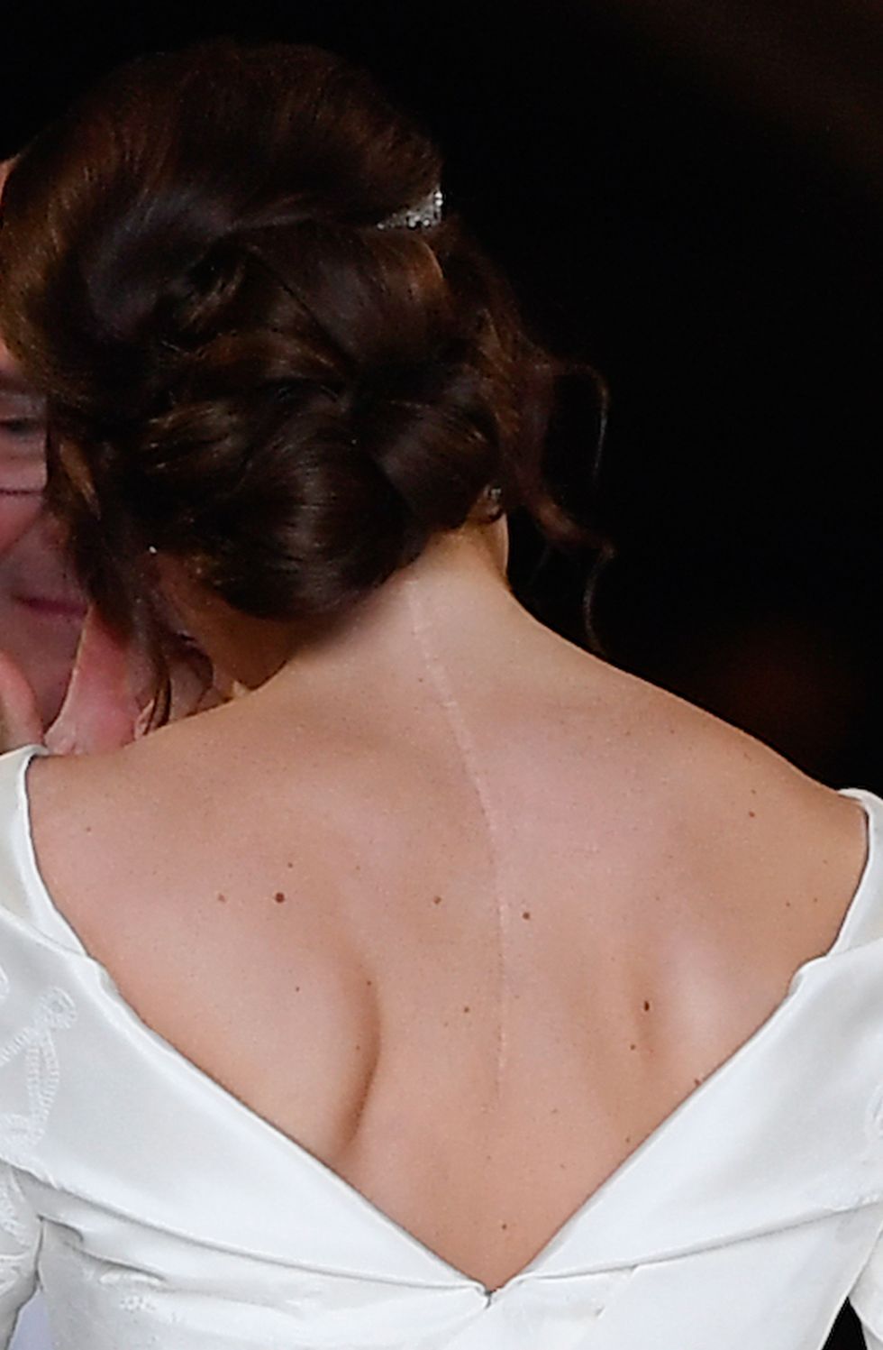 the scar on the back of britains princess eugenie of york is clearly visable as she arrives for her wedding to jack brooksbank at st georges chapel, windsor castle, in windsor, on october 12, 2018 photo by toby melville  pool  afp        photo credit should read toby melvilleafp via getty images