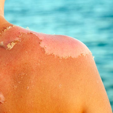 Skin peeling Skin peeling