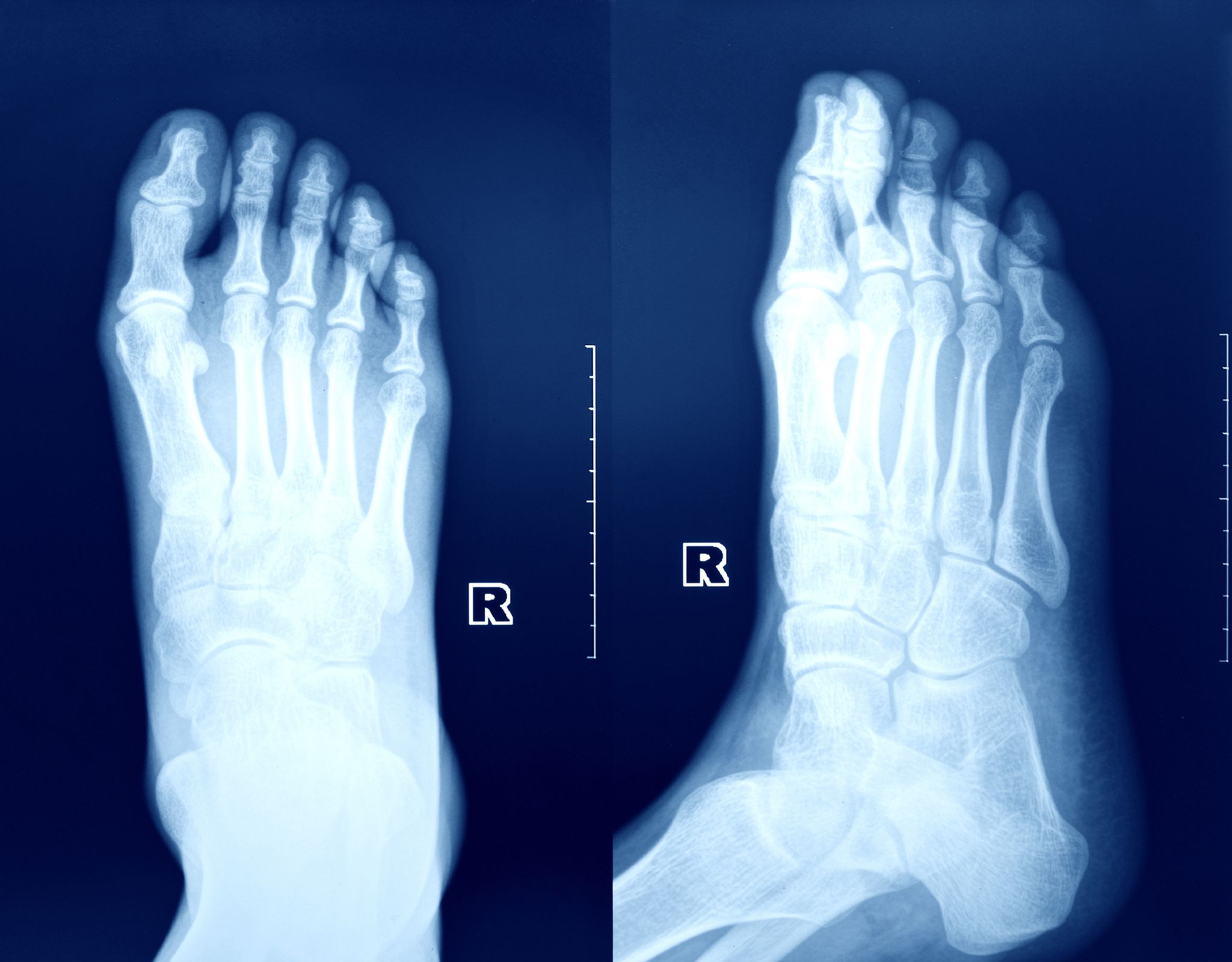 Ankle Fractures - Foot Health Facts - Foot Health Facts