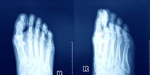 x ray image of the foot