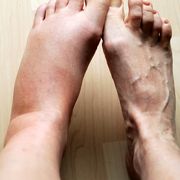 reasons for swollen feet