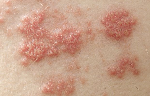 Is shingles contagious