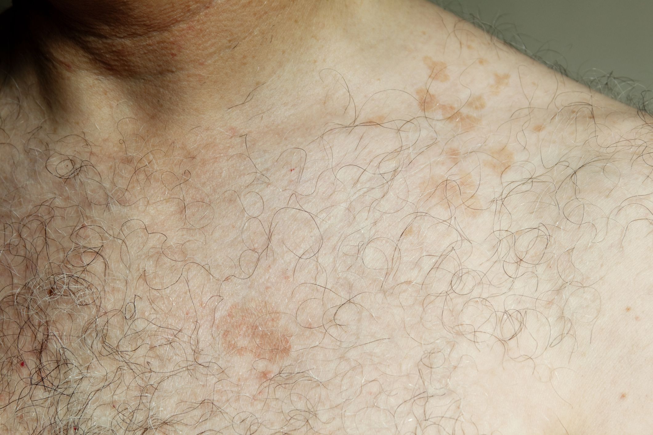 Skin Concerns] Have y'all ever seen tinea versicolor this bad before? I  have tried every anti-fungal cream, anti-fungal pill course (prescribed by  a doctor), selsun blue. It goes away, then literally just