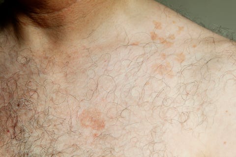 Tinea Versicolor Treatment - How to Get Rid of Tinea Versicolor