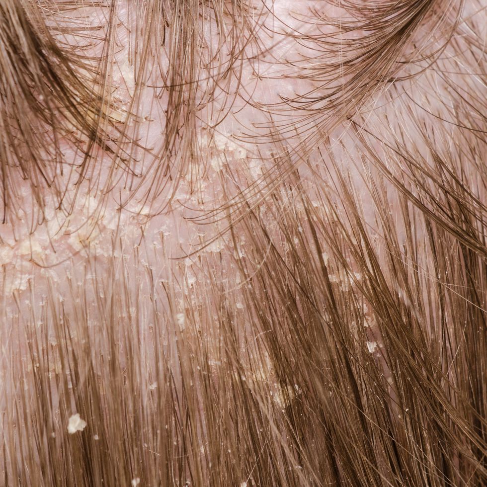 dandruff in the hair of a person