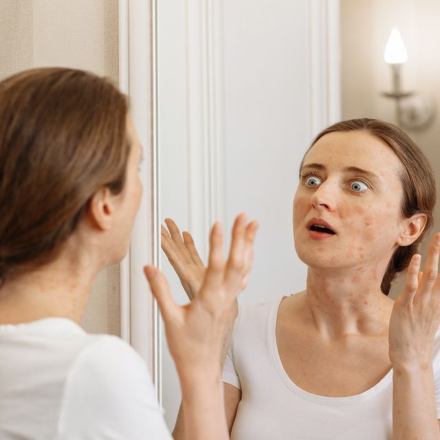 the girl looks in surprise at her problem skin in the mirror the phase of exacerbation of skin diseases and its manifestations