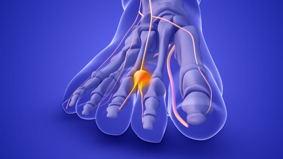 neuroma di morton, dolore ai piedi, runner