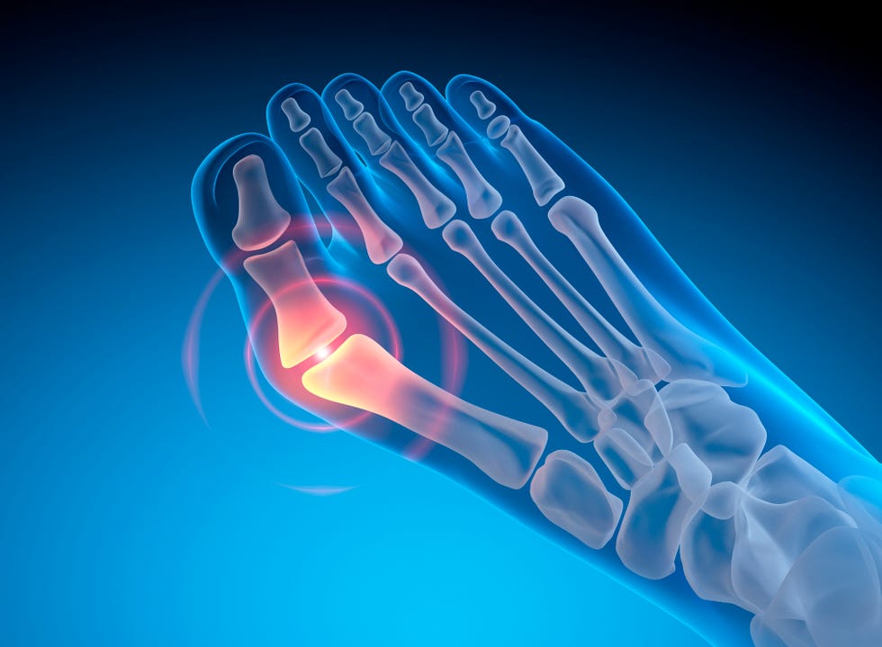 hallux valgus valgus deformity of the big toe x ray 3d illustration with blue background