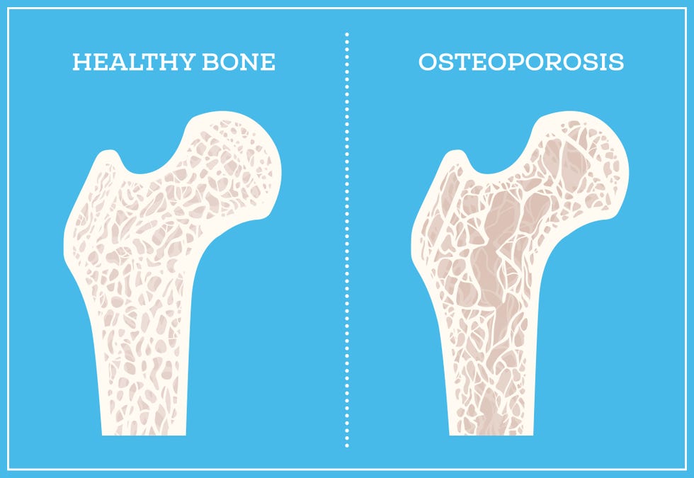 osteoporosis