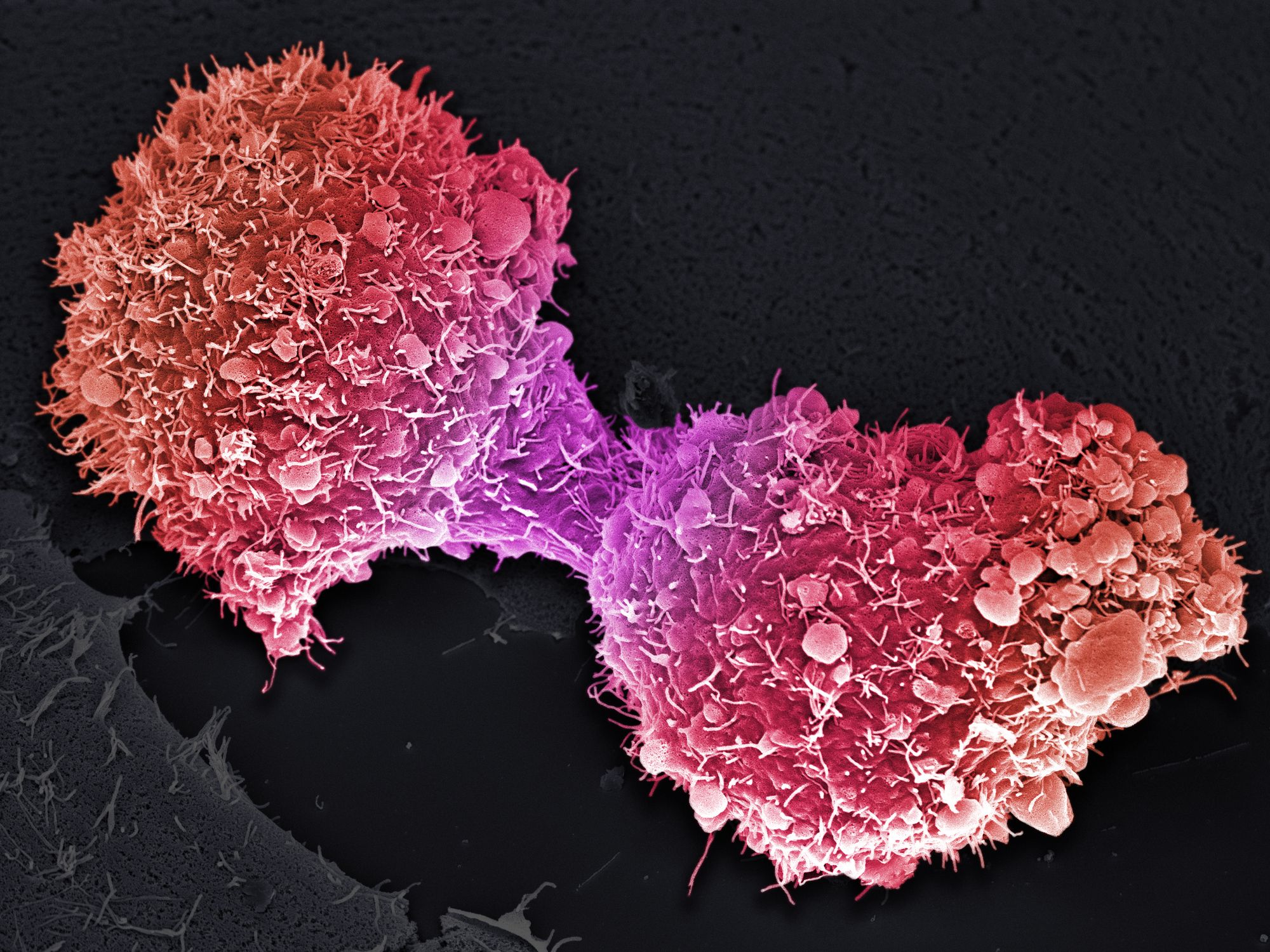 Pancreatic cancer cells completing division.