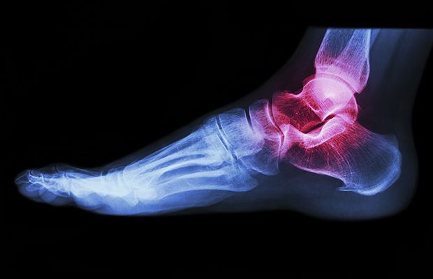 Arthritis in foot