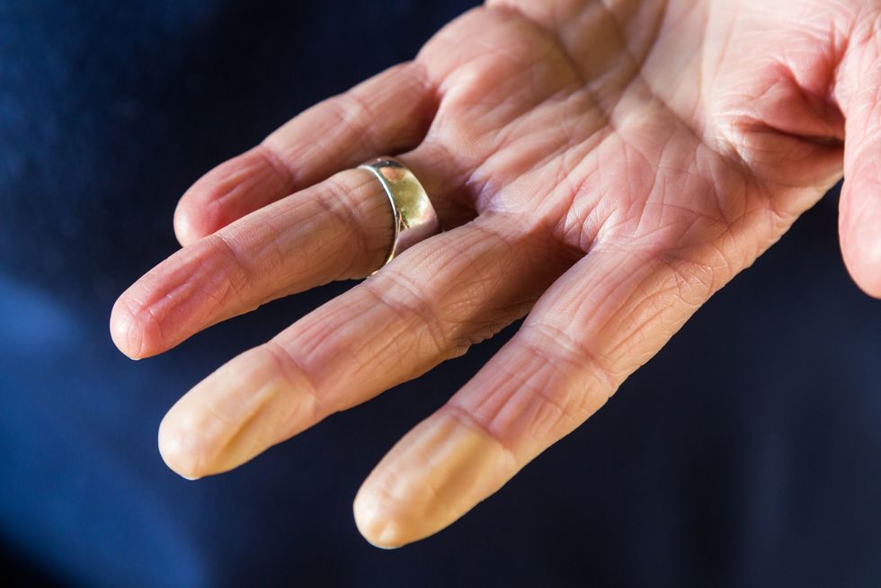 raynaud's disease - white fingertips