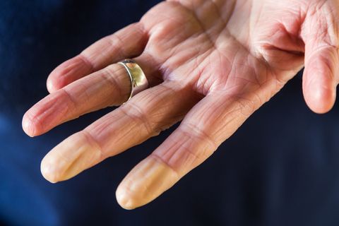 raynaud's disease - white fingertips