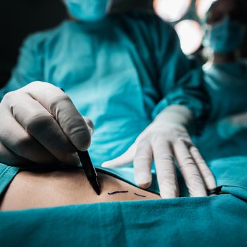 een close up van een plastisch chirurg die lijnen zet op de huid van de patiënt voor de operatie