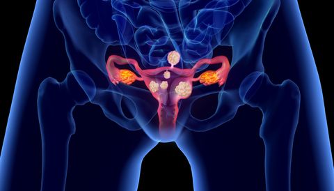 uterine fibroids
