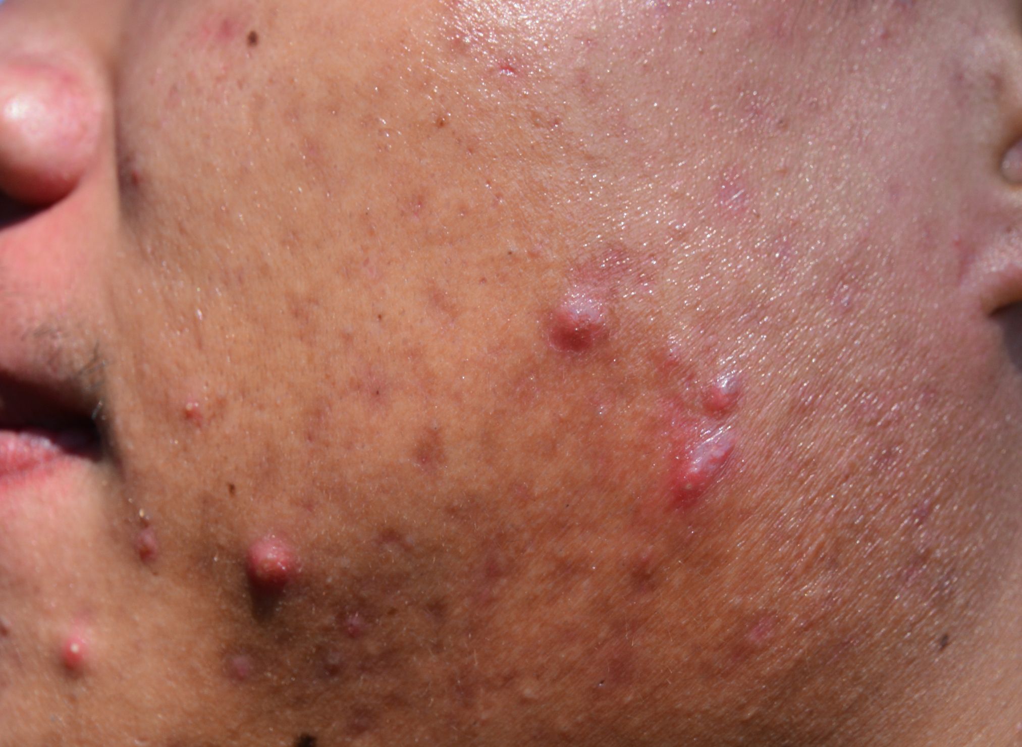 acne on skin face