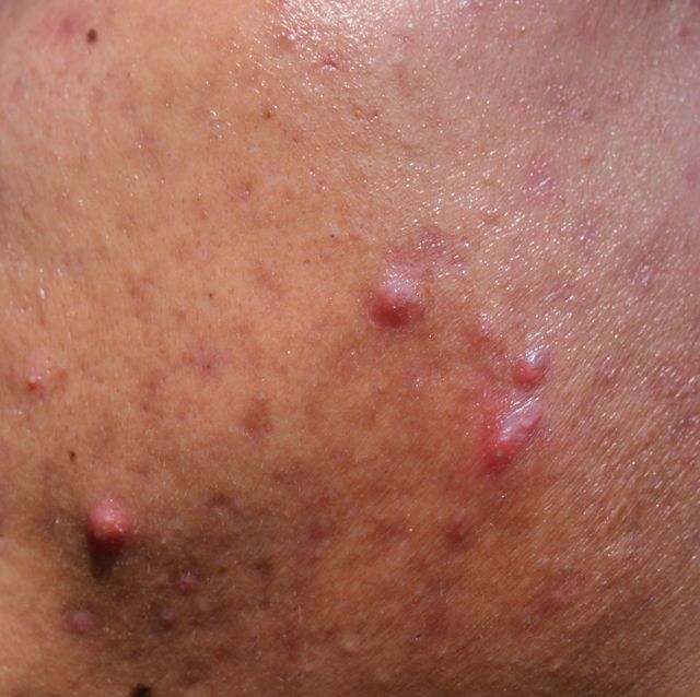 acne on skin face