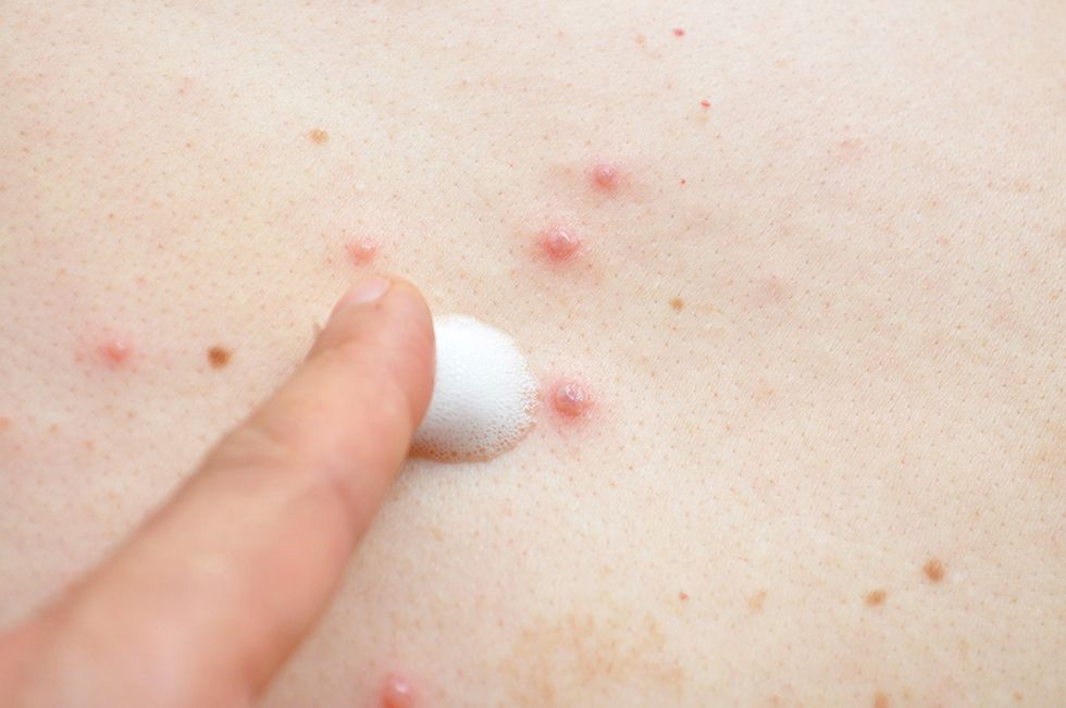 Smallpox close-up
