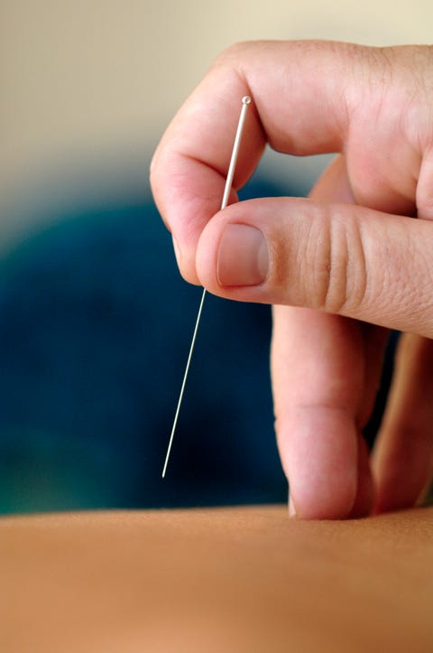 acupuncture treatment