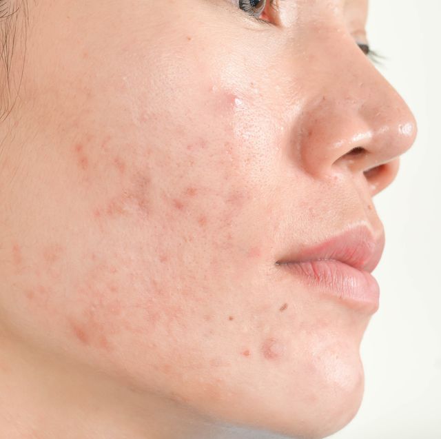 6 Adult Acne Causes And How To Get Rid Of It, Say Dermatologists