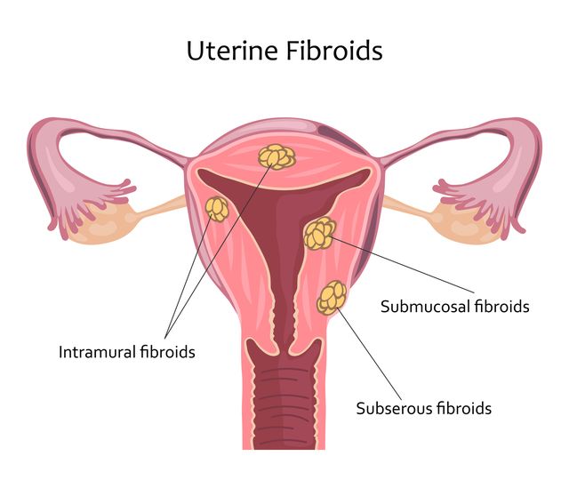 uterine fibroids location