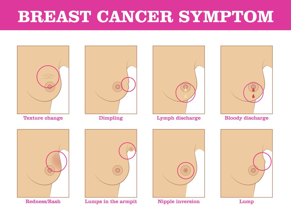 Breast cancer symptoms you shouldn't ignore