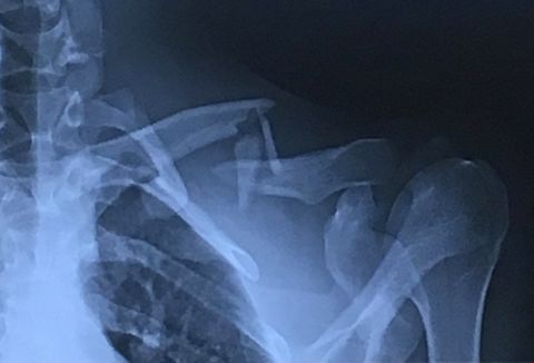 full frame of an xray image of a human shoulder with a broken clavicle or collarbone