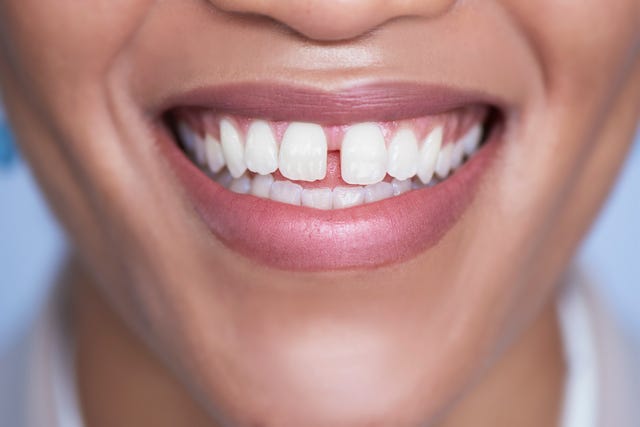 closeup of a smiling mouth and white teeth with gap