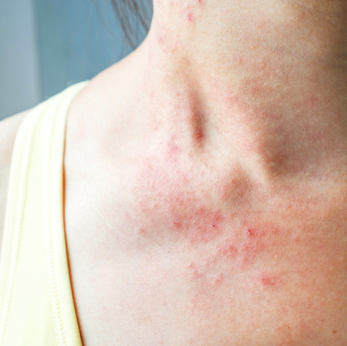 Rash Guide: Causes, Symptoms and Treatment Options
